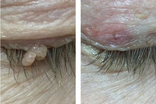 skin tag removal in Lymington-